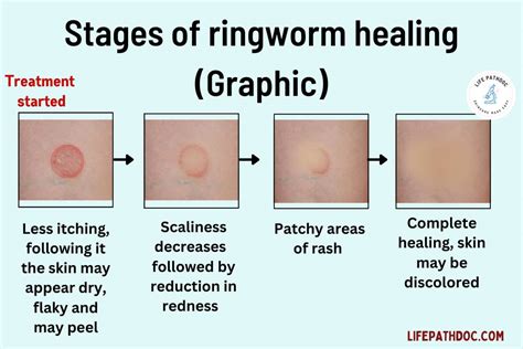 Ringworm stages - Sections of hair may break off near the scalp, leaving scaly, red areas or bald spots. You may see black dots where the hair has broken off. Left untreated, these areas can gradually grow and ...